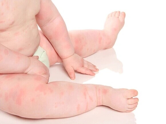Tipos de alergias en bebés